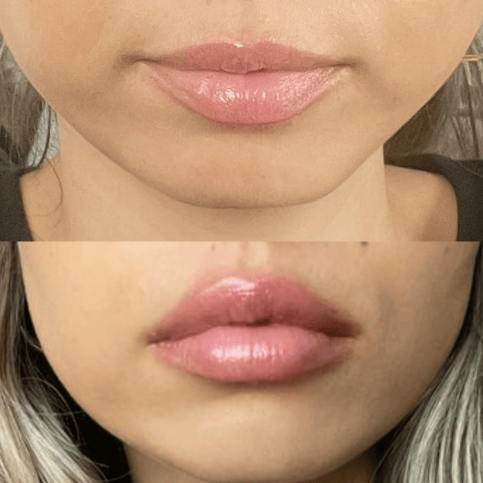 LIP VOLUMIZER